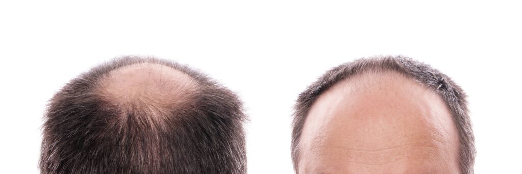 Image of man experiencing hair loss